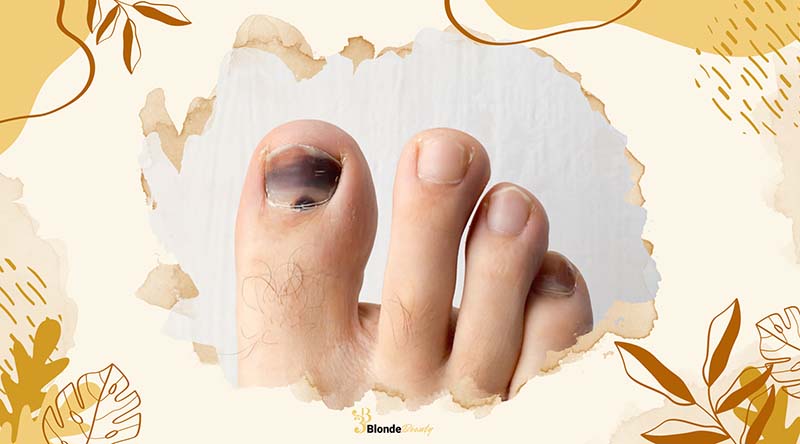 How to Heal a Bruised Toe Nail